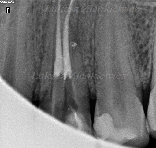 Wygojona zmiana zapalna zęba podczas leczenia kanałowego po 11 miesiącach