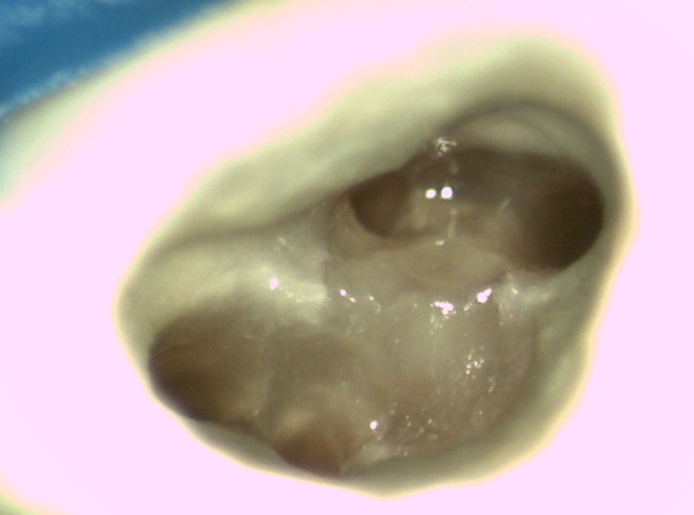 widok zęba widocznego podczas leczenia kanałowego w mikroskopie w powiększeniu 20x