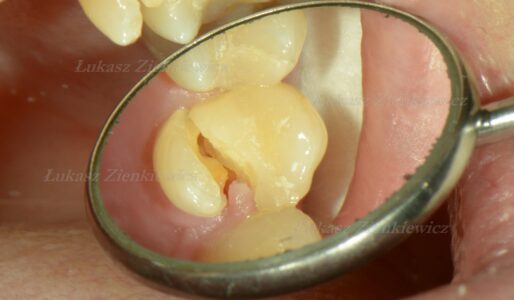 Złamany ząb, powiększony narzędziem stomatologicznym