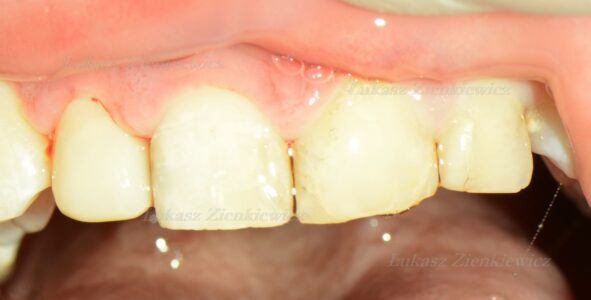 zdjęcie złamanego zęba nr. 2 bezpośrednio po odbudowie zęba