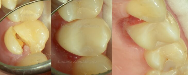 ząb złamany, porównanie przed i po zabiegu stomatologicznym