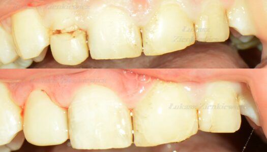 Porównanie zęba nr. 2 przed i po złamaniu 