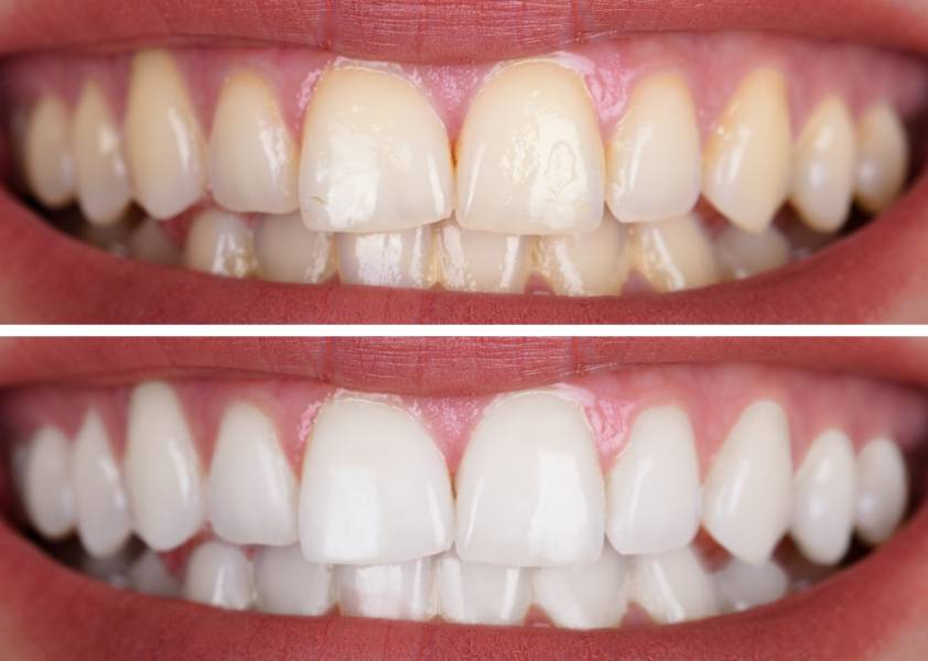 wszystkie zęby przed i po higienizacji