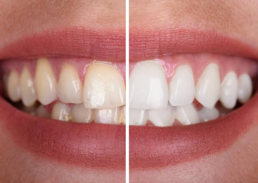 efekt przed i po higienizacji zębów