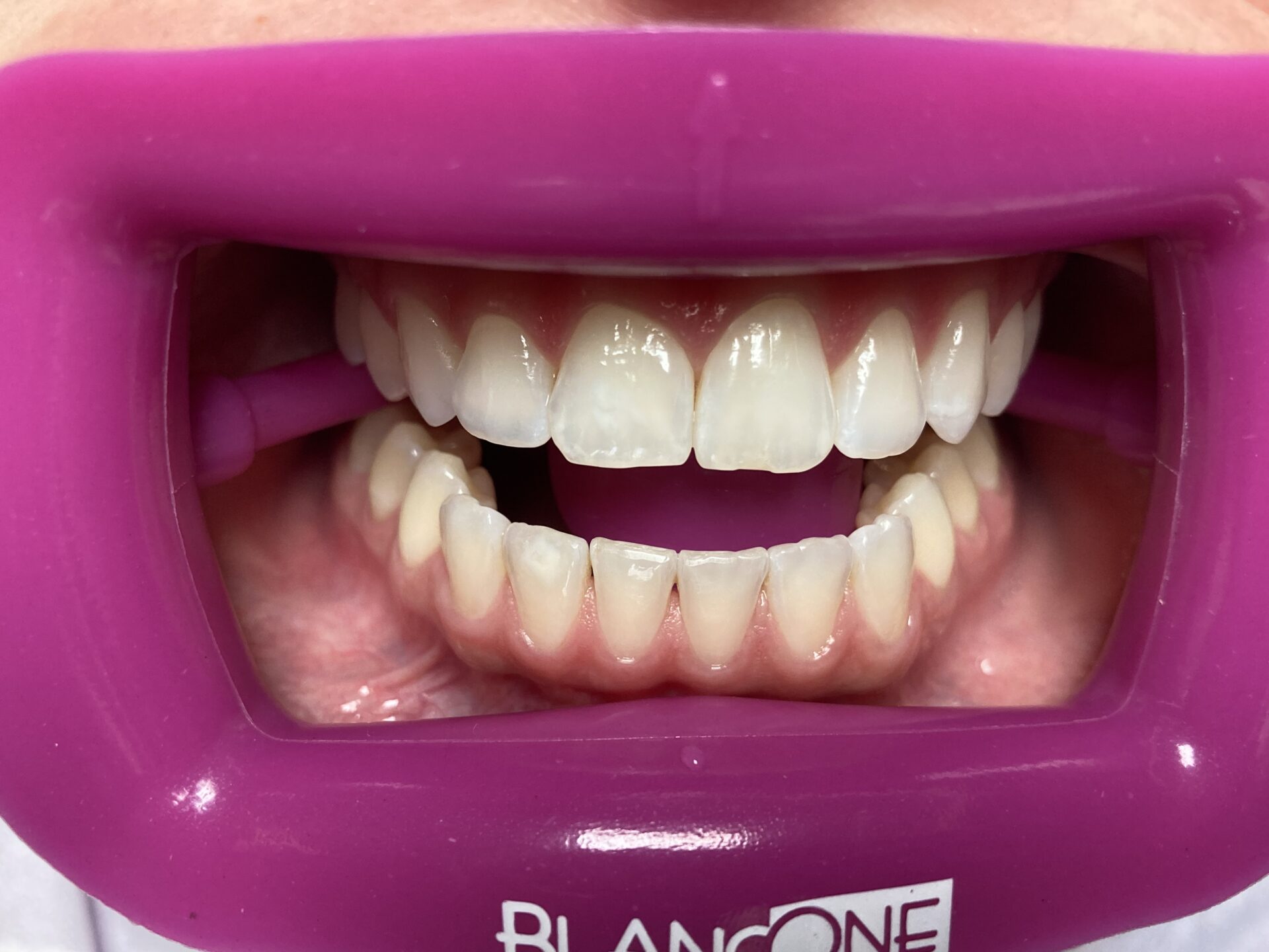 zęby przed wybielaniem metodą BlancOne