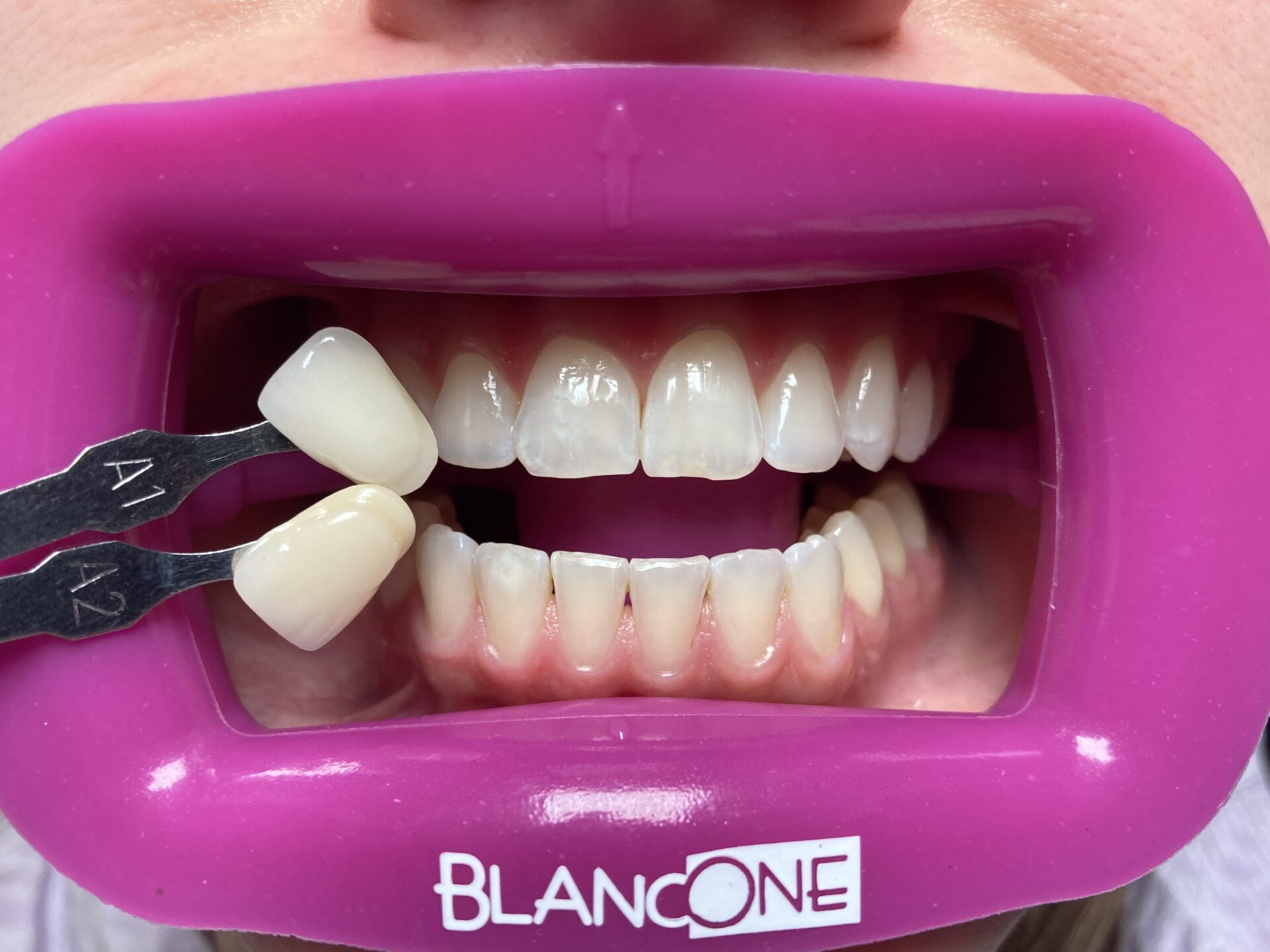 zęby przed wybielaniem metodą BlancOne wraz z kolornikiem Vita